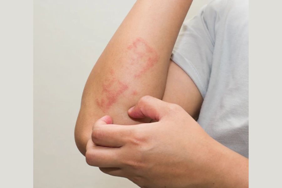 Understanding Skin Diseases: Psoriasis, Eczema, and the Role of Homeopathy